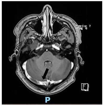 Case Report: Cerebral Venous Sinus Thrombosis in a Young Child With SARS-CoV-2 Infection: The Italian Experience